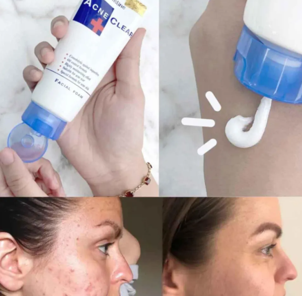 Sữa Rửa Mặt Cho Da Mụn Mistine Acne Clear Facial Foam Thái Lan 100ml - Ảnh 2